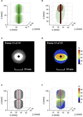 Intraductal magnetic resonance imaging of cholangiocarcinoma - a practical possibility